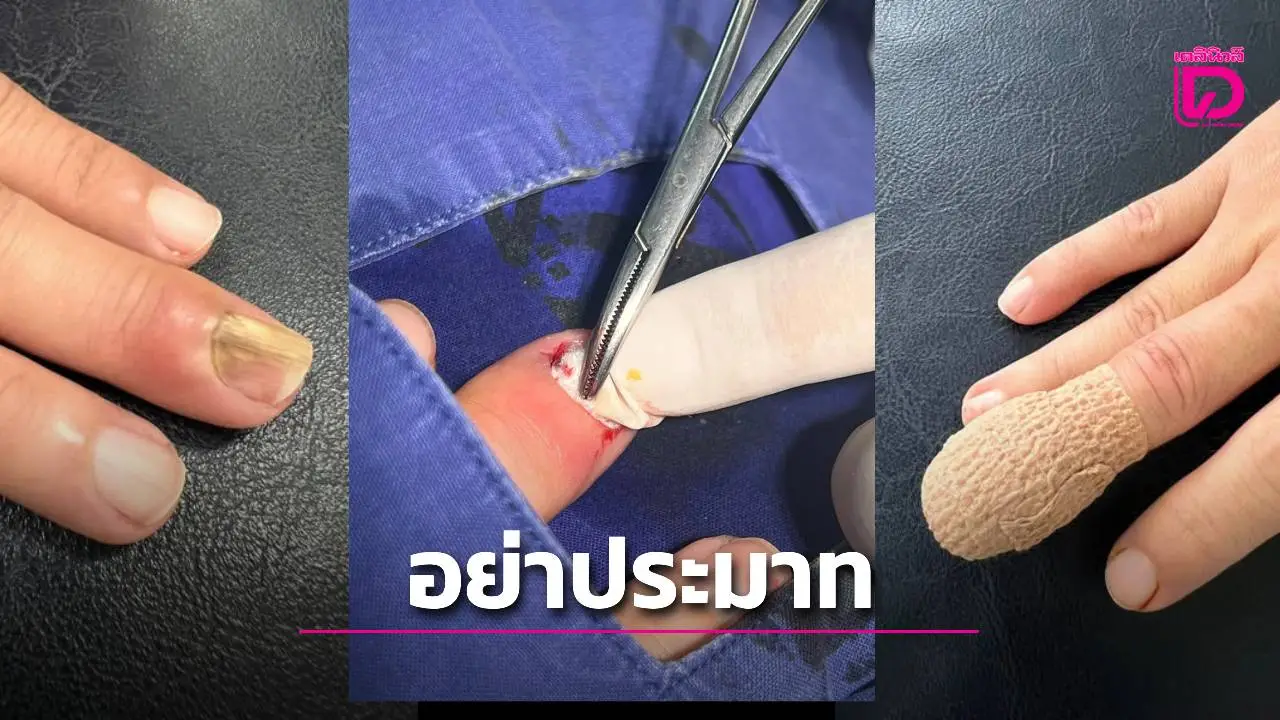 เตือนภัย! หมอแชร์ประสบการณ์ 'ถอดเล็บติดเชื้อ' หลังทำสวน ชี้หากประมาทอาจลามถึงกระแสเลือด