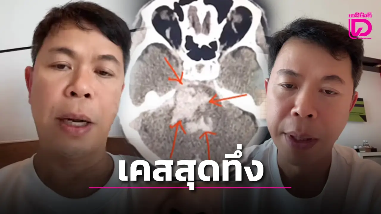 ‘หมอประชา’ แชร์เคสชายวัย 29 ปีเลือดออกก้านสมอง พร้อมข้อคิดคุมปัจจัยเสี่ยง