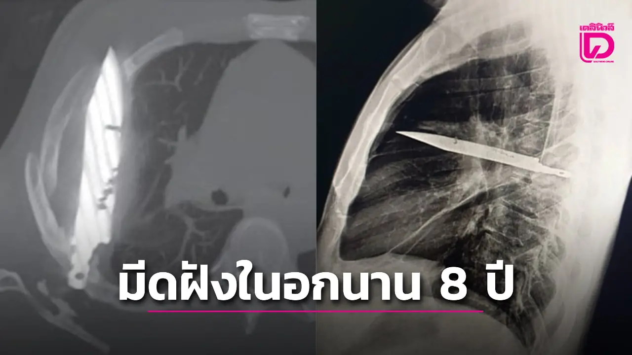 หนุ่มใหญ่สุดช็อก แพทย์ตรวจเจอมีดฝังในช่องอกนาน 8 ปีโดยไม่รู้สึกตัว