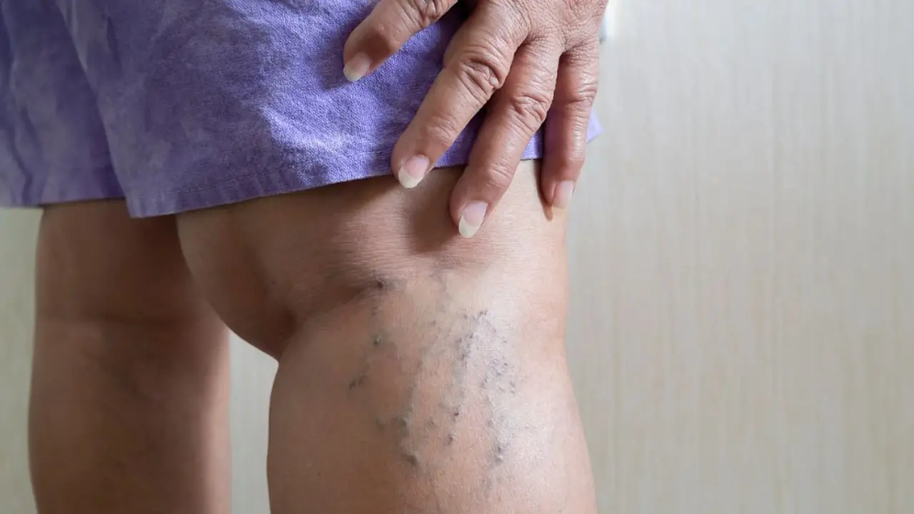 Thana Varicosevein Clinic รักษาเส้นเลือดขอดครบวงจร ดูแลโดยแพทย์เฉพาะทาง