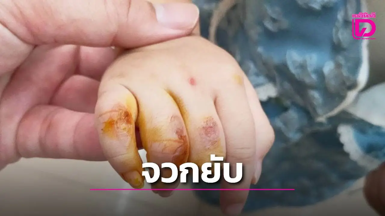 เตือนภัย! ลูกถูกเตารีดลวกมือเพราะคิดว่าเป็นของเล่น ด้านชาวเน็ตจวกยับ