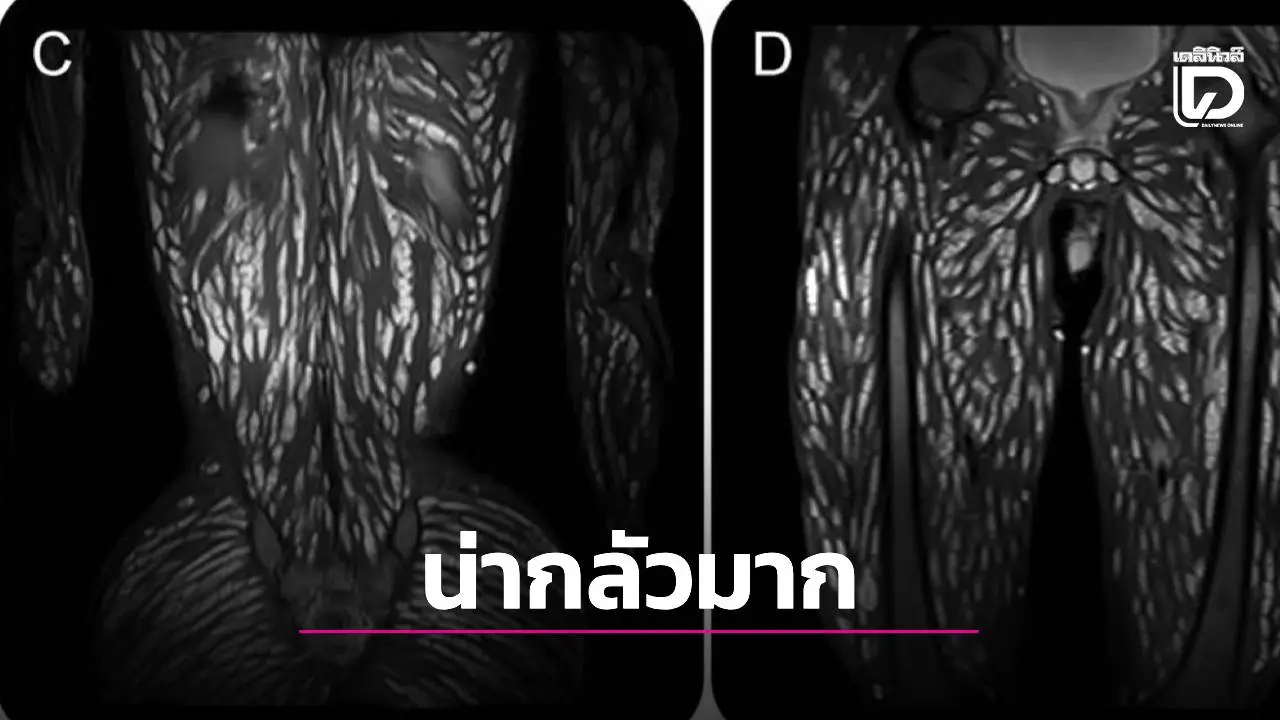 ช็อกวงการแพทย์! เด็ก 18 แข็งแรงดี แต่ร่างกลายเป็นอาณาจักรพยาธิ หมอเตือนภัย 'ผักสดที่ล้างไม่สะอาด'
