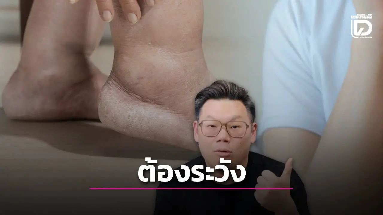 ระวัง 'บวมข้อเท้า–หน้าบวม–น้ำหนักขึ้นเร็ว' สัญญาณเตือนไตเริ่มเสื่อม