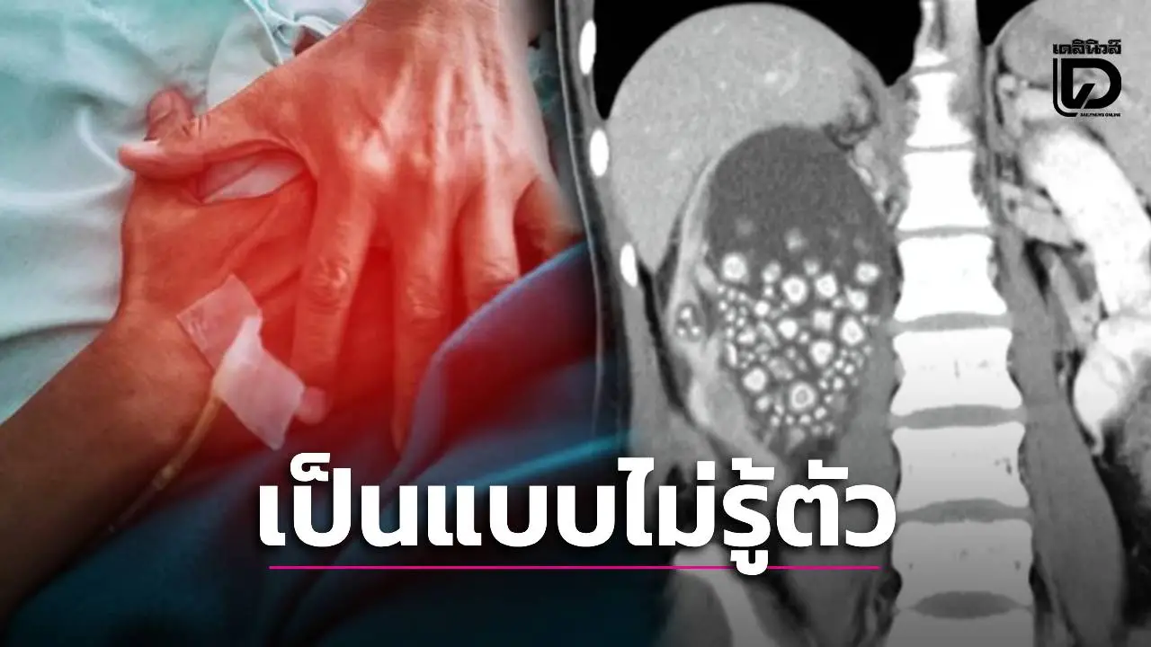 ‘หมอเจด’ เตือนเป็น ‘นิ่วในไต’ แบบไม่รู้ตัว เพราะ 5 เครื่องดื่มนี้!