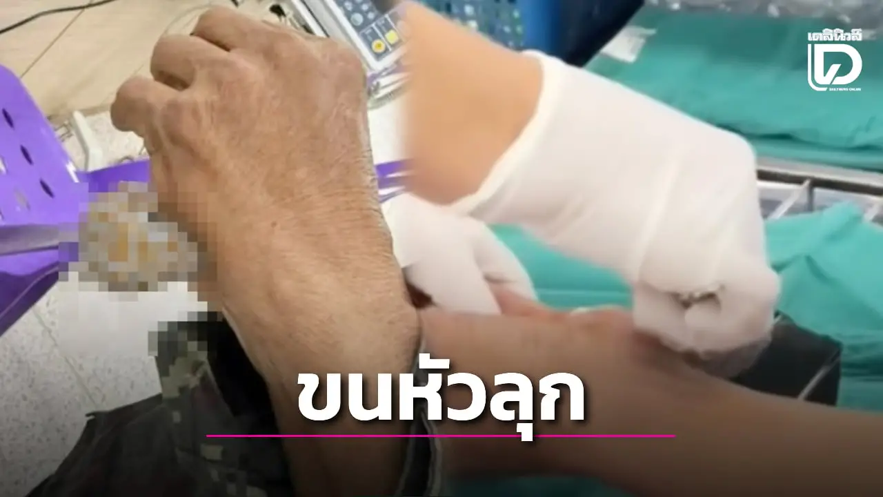 สุดสะพรึง! ‘ตุ๊กแก’ กัดติดฝ่ามือคนไข้ไม่ยอมปล่อยแม้ถูกตัดหัว
