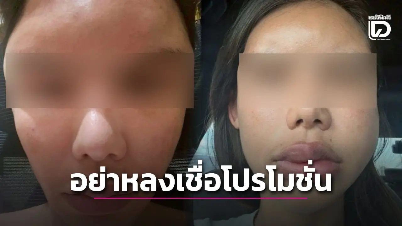สาวสุดช้ำ! หลงเชื่อโปรฯ ฉีดฟิลเลอร์ สุดท้ายหน้าบวม-เบี้ยว รักษานานร่วม 2 ปี