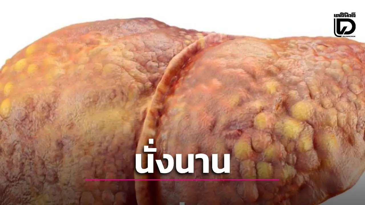 นั่งนาน = ตับพัง! 'หมอสุรัตน์'เตือนภัยเงียบ 'ไขมันพอกตับ' จากพฤติกรรมติดเก้าอี้