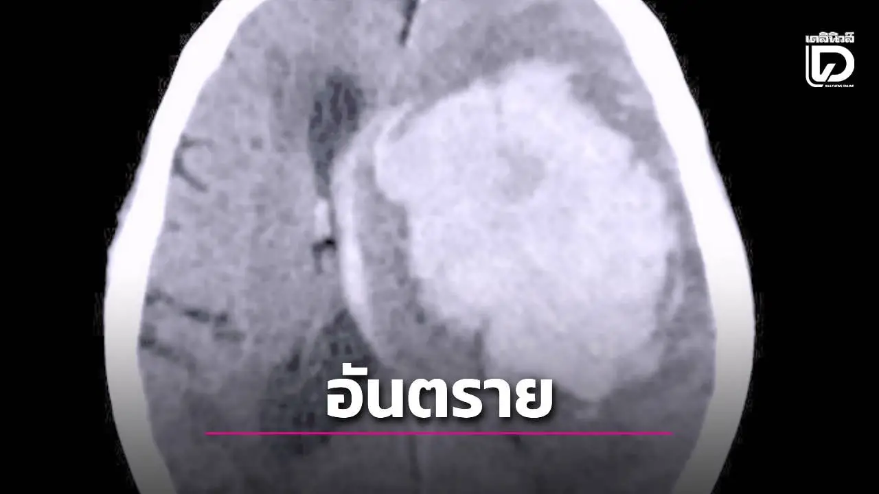 เช็กด่วนก่อนสาย! 5 วิธีสยบ 'ความดันพุ่ง' ป้องกันภาวะสมองแล่บกดก้านสมอง ดับกะทันหัน