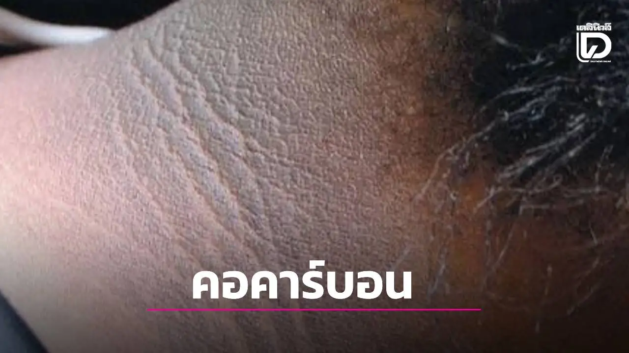 ชร์ว่อน! 'คอคาร์บอน' ขัดยังไงก็ไม่ออก แฉสัญญาณอันตราย 'ภาวะดื้ออินซูลิน' เสี่ยงเบาหวาน